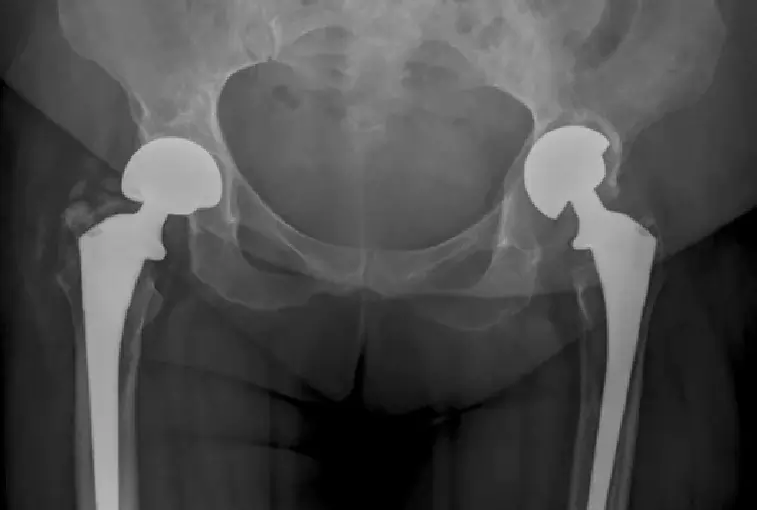 Hemiarthroplasty