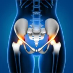 Hip Replacement Surgeon in Jaipur